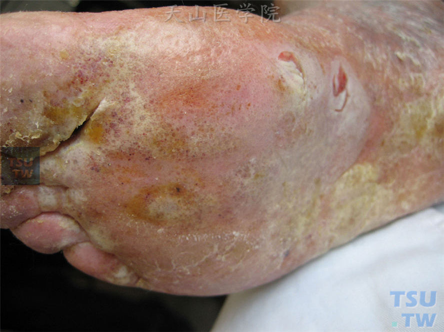 足癣加重，整个足跖、足趾、趾间密集针尖大小深在性水疱、糜烂、渗液、结痂，红肿明显