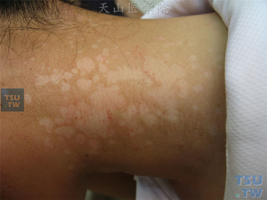花斑糠疹：颈部大小不等的色素减退斑