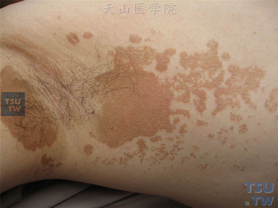 花斑糠疹：腋窝及周围大小不等褐色斑片