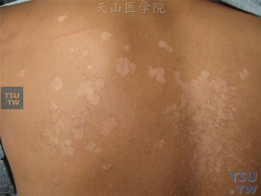花斑糠疹：同一病人，后背皮损