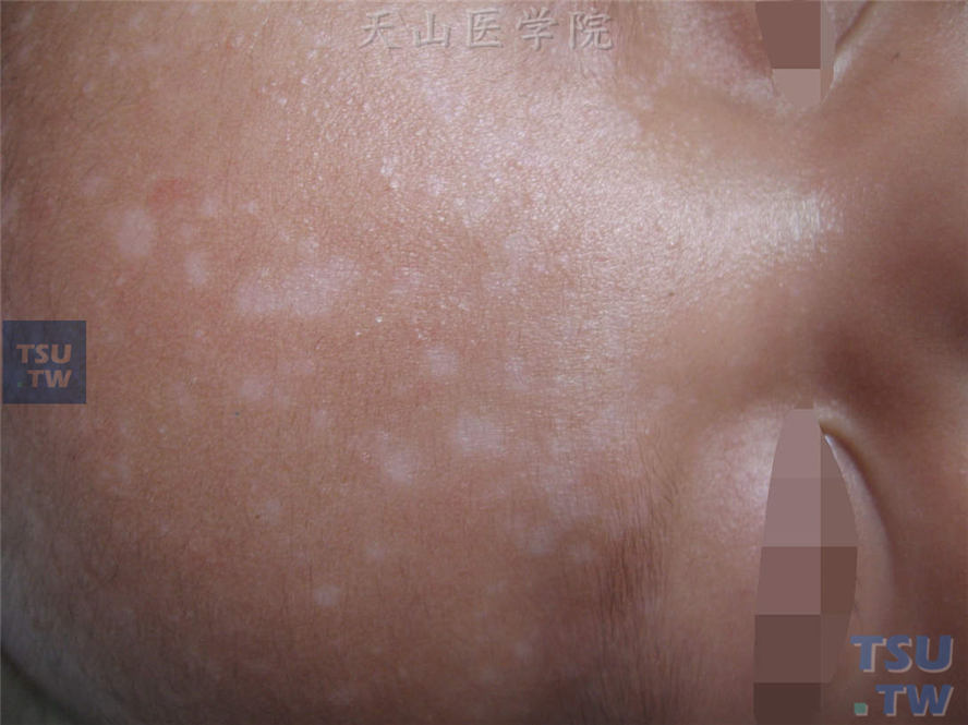 花斑糠疹：幼儿前额大小不等圆形或类圆形色素减退斑，个别表面覆以少许细碎灰白糠秕状鳞屑