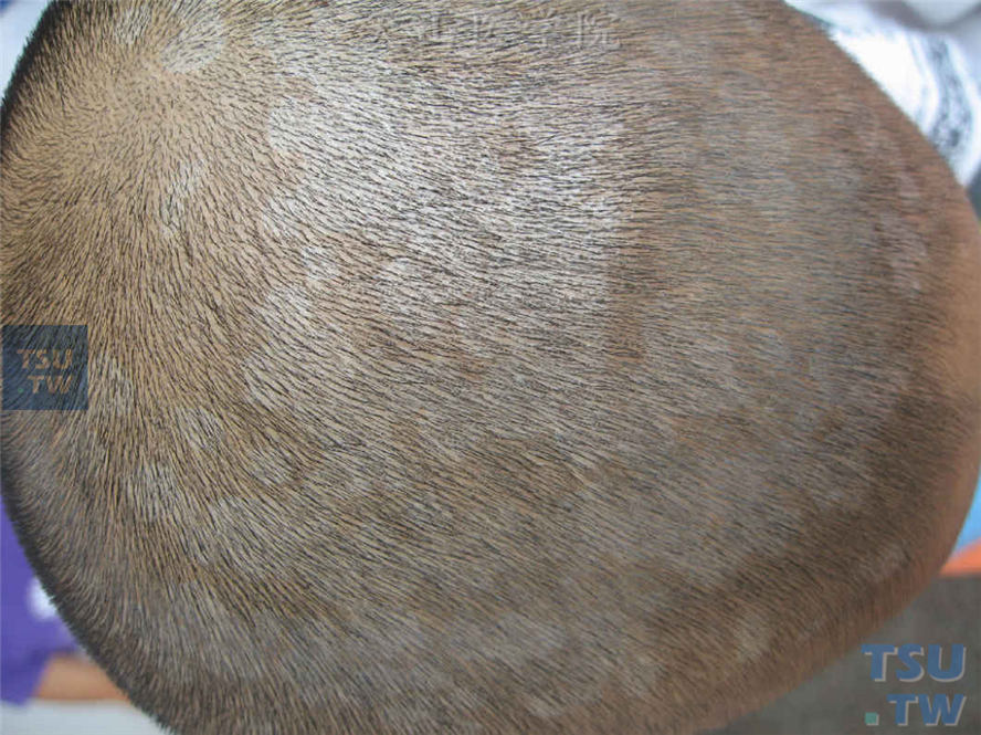 花斑糠疹：头皮大小不等的圆形色减斑，皮损密集处融合成片