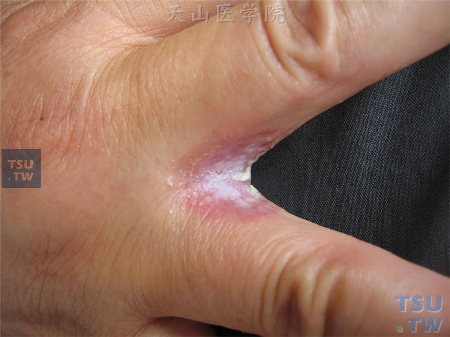 念珠菌性间擦疹：指间潮红、浸渍、糜烂，边缘附着鳞屑