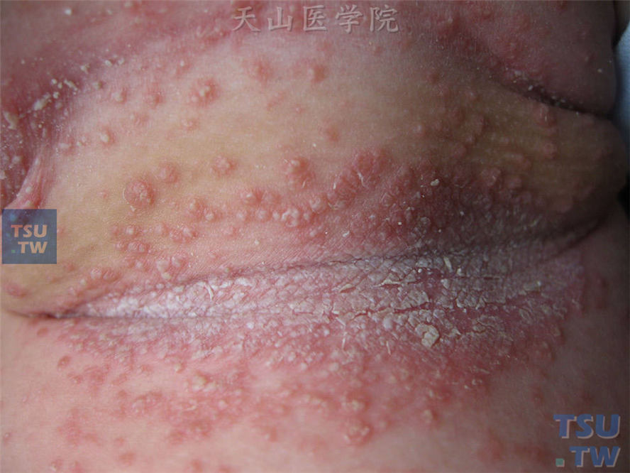 念珠菌性间擦疹：皱褶部位潮红、浸渍、糜烂，外周炎性丘疹、丘脓疱疹