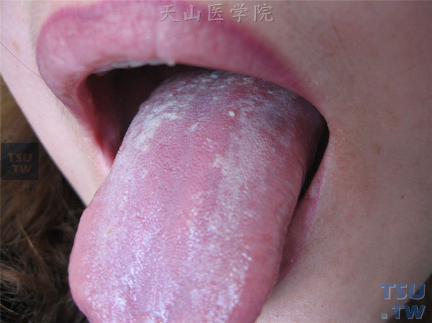 口腔念珠菌病（又称鹅口疮）：舌背凝乳状白色斑片，不易剥除，用力剥离后露出糜烂性潮红基底