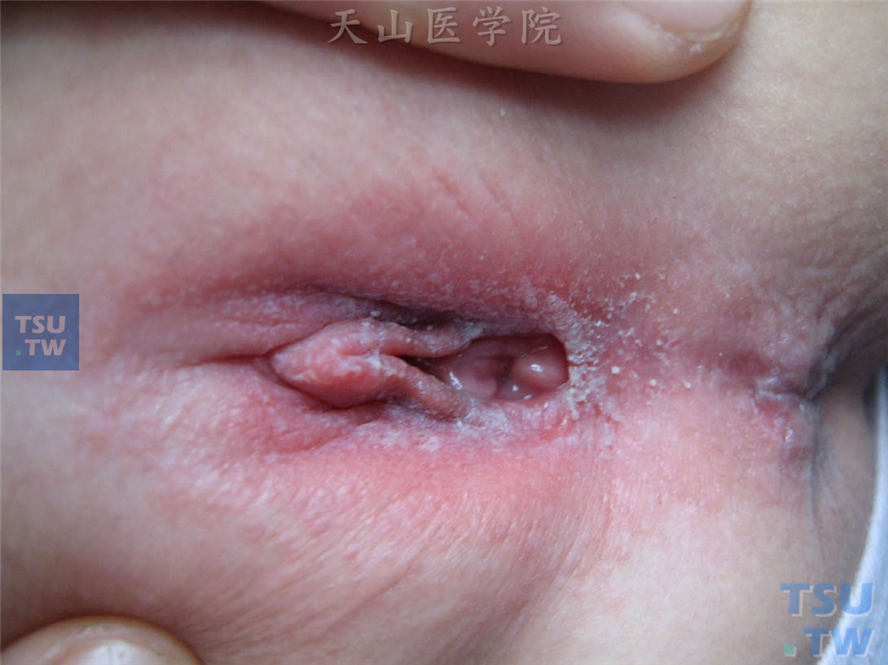 外阴阴道念珠菌病：外阴黏膜红肿，表面被覆白色凝乳状白色伪膜样物，基底为潮红糜烂面