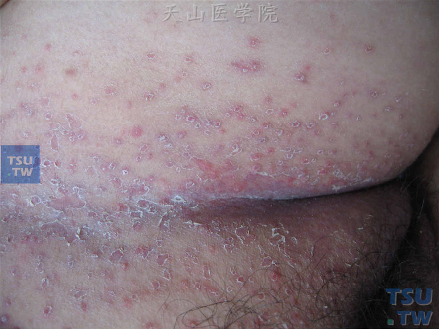 念珠菌病：腹股沟处丘疹、丘疱疹，表面领圈状脱屑