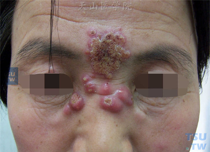 局限型皮肤型：面部多发大小不等紫红色结节或浸润性斑块，表面可见脓疱或坏死形成的溃疡结痂