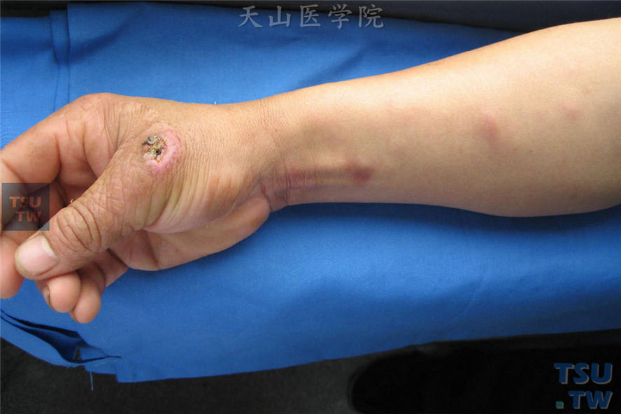 皮肤淋巴管型：四个结节性损害沿淋巴管走行分布，表面皮肤紫红，手背部结节中央坏死形成溃疡