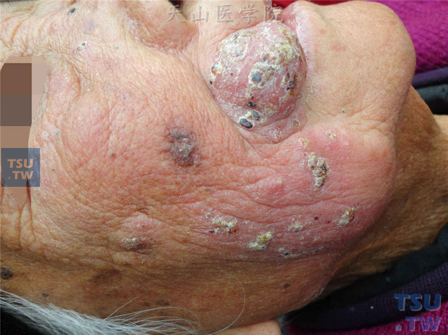 毛霉菌性肉芽肿（mucormycosis granuloma）的症状表现