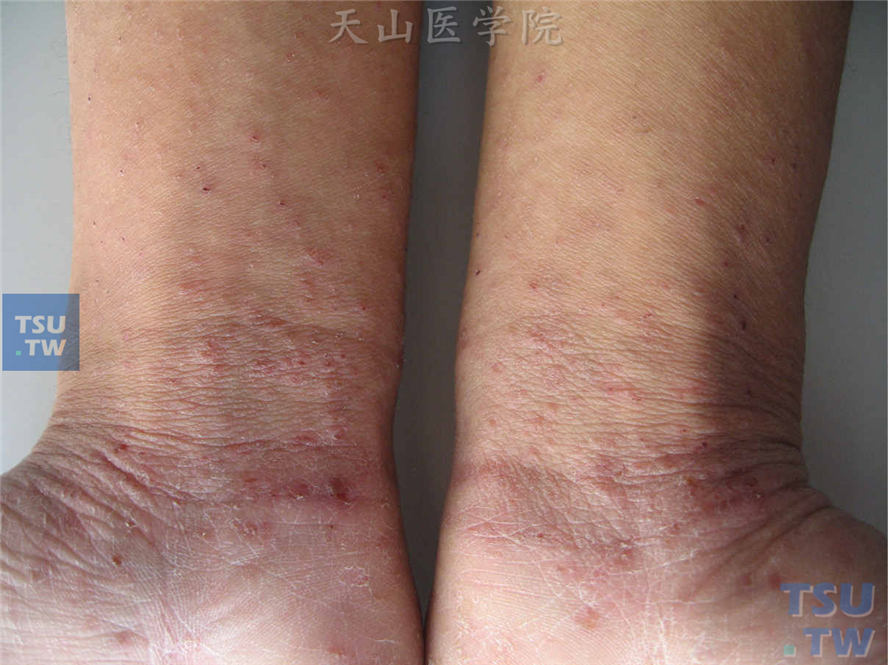 疥疮症状：手腕部米粒大小淡红色丘疹、丘疱疹、抓痕