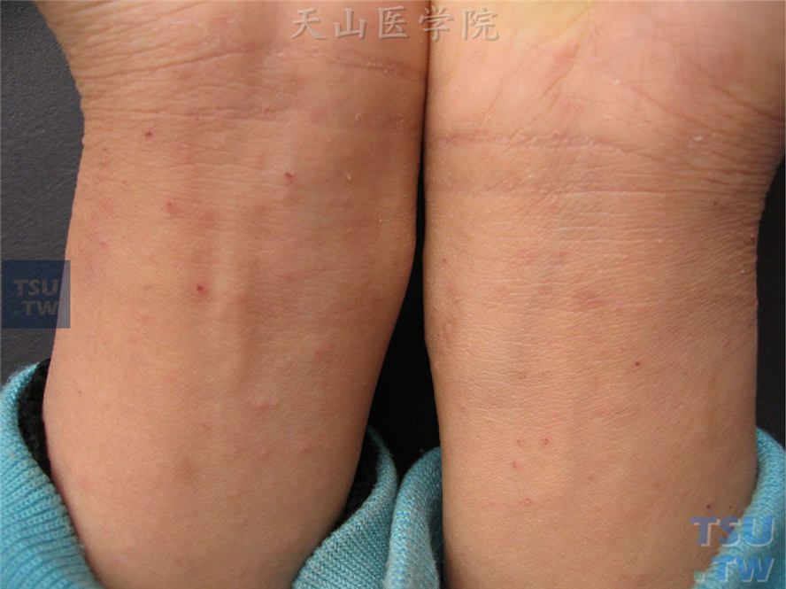 疥疮症状：手腕屈侧散在淡红色丘疹、丘疱疹