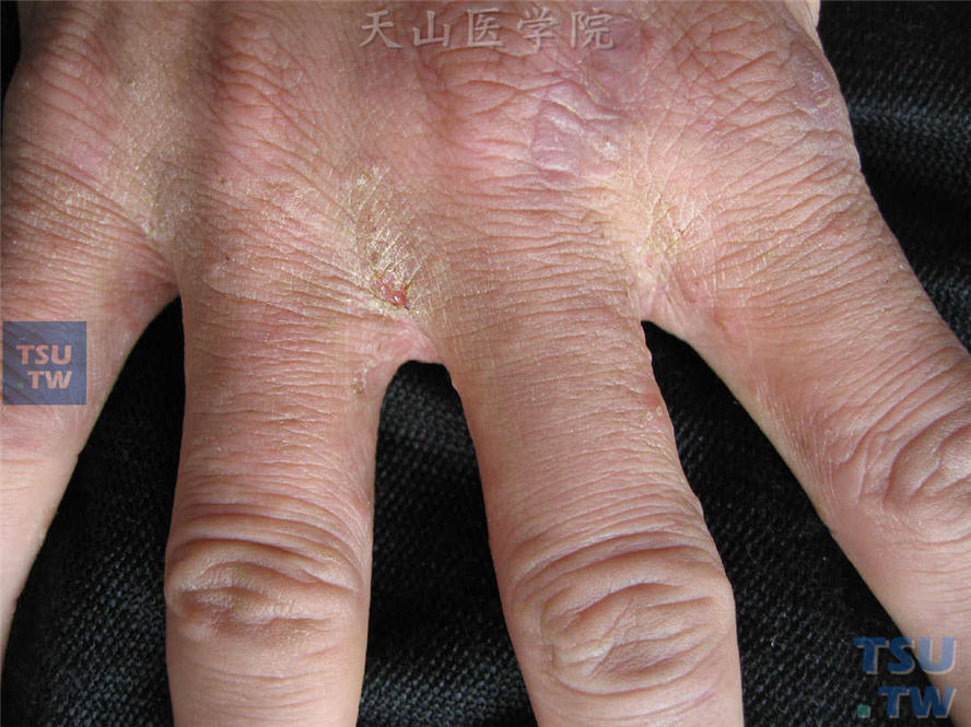 疥疮症状：指缝米粒大小丘疹、丘疱疹、隧道