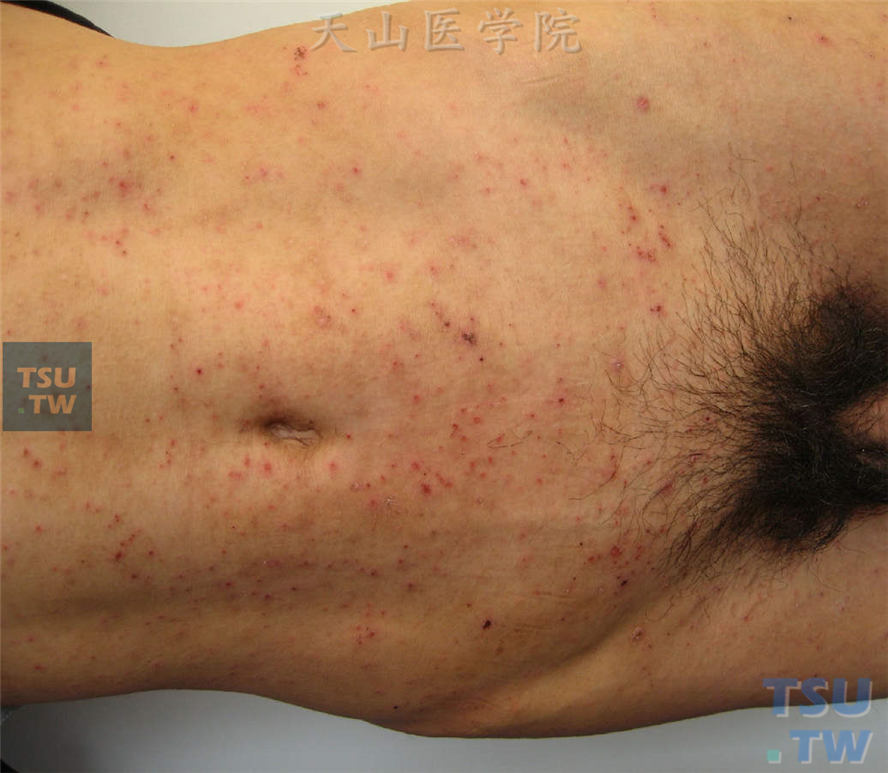 疥疮症状：腹部、大腿内侧粟粒至米粒大小淡红色丘疹，表面抓破结痂