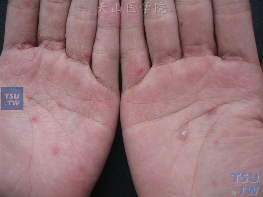 疥疮症状：儿童疥疮：手掌散在斑丘疹、丘疱疹