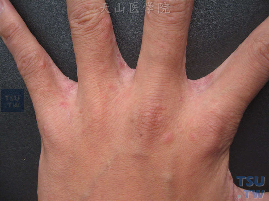 疥疮症状：同一患儿，指缝皮损