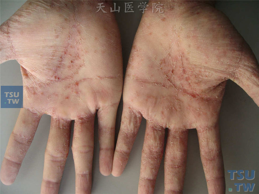 疥疮症状：手掌皮损，病史较长，按湿疹、癣反复应用过多种外用药物