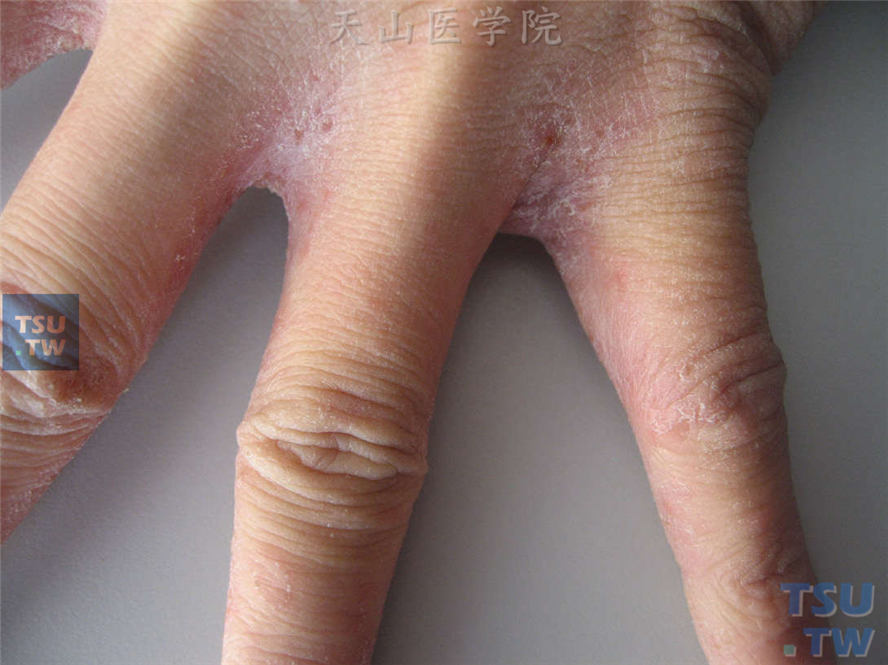 疥疮症状：同一病人，指缝损害