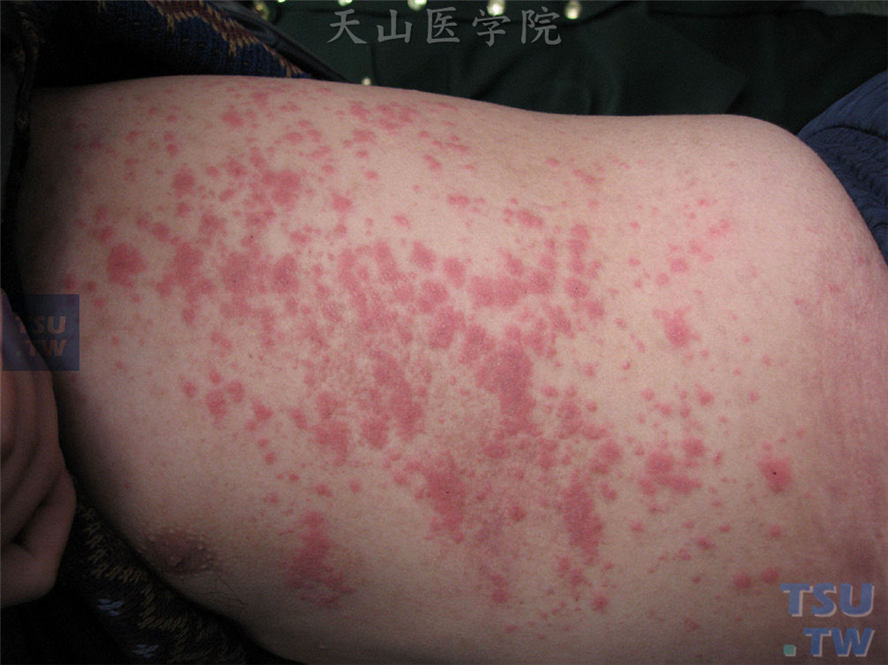 螨皮炎（acarodermatitis）的症状表现