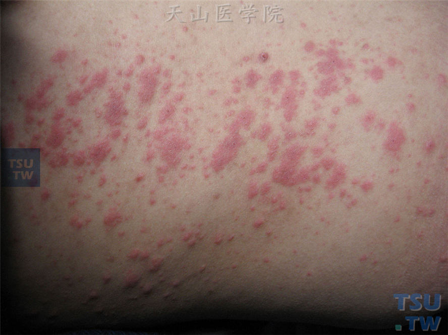 躯干部位密集分布大小不等水肿性丘疹、斑丘疹，部分融合，呈紫红色