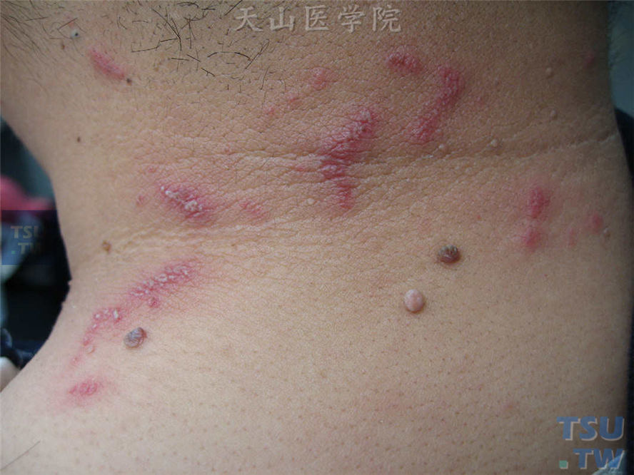 颈部点状或线状水肿性紫红斑，其上密集水疱