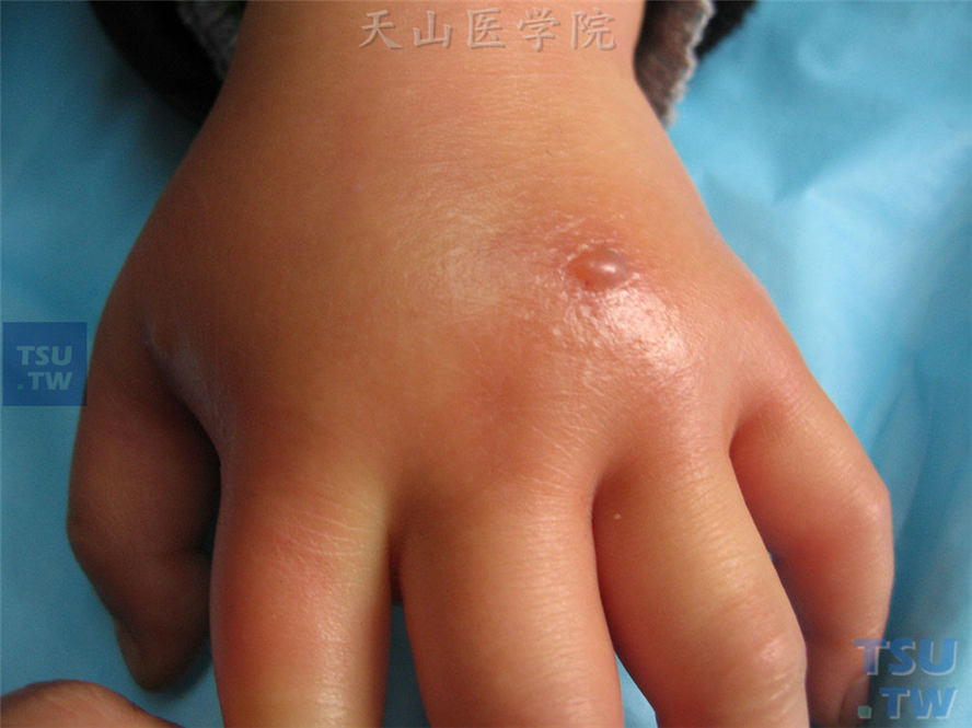 手背、手指背侧高度红肿，中央可见水疱，伴有胀痛