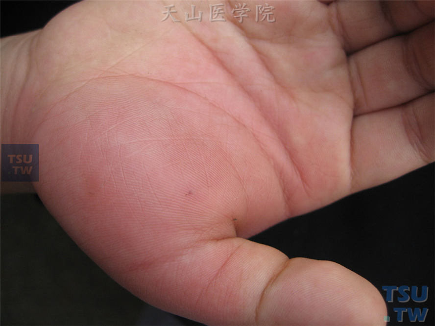 蜂蜇伤，表现为局部水肿性红斑，中央可见针尖大小的出血点