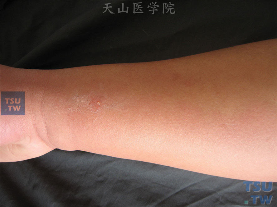 前臂大片水肿性红斑，中央可见米粒大小张力性水疱