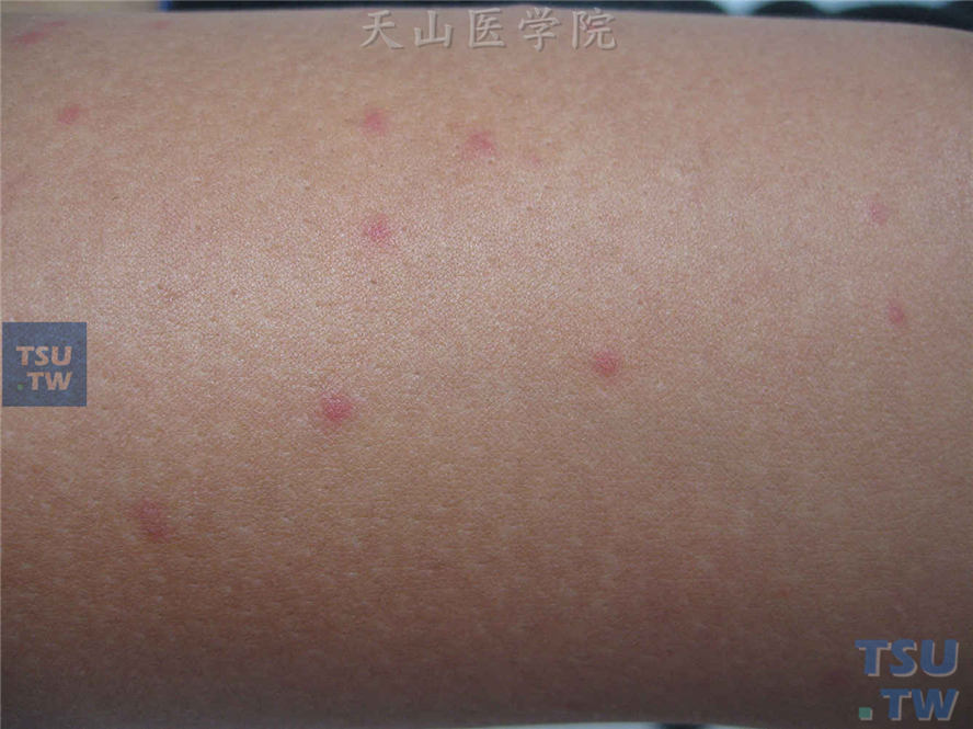 蚊虫叮咬（mosquito bite）