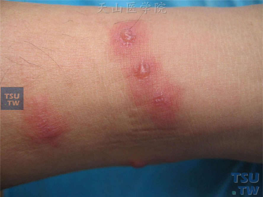 小腿数枚水肿性红斑，中央水疱，成线状排列