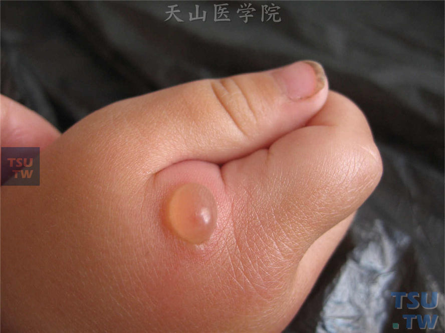 手背水肿性红斑，中央花生米大小张力性水疱