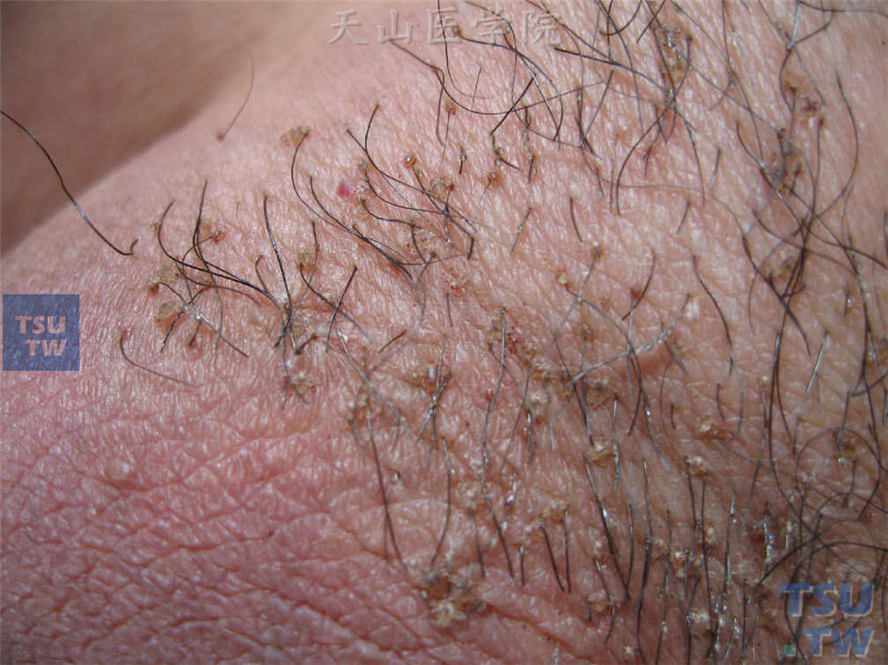 阴虱：阴毛毛干上附着白色虫卵，根部可见灰褐色成虫，虱叮咬的皮肤可见红斑、丘疹
