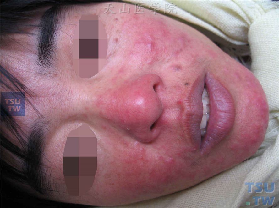 面部毛细血管扩张性红斑，其上毛囊性炎性丘疹、丘脓疱疹
