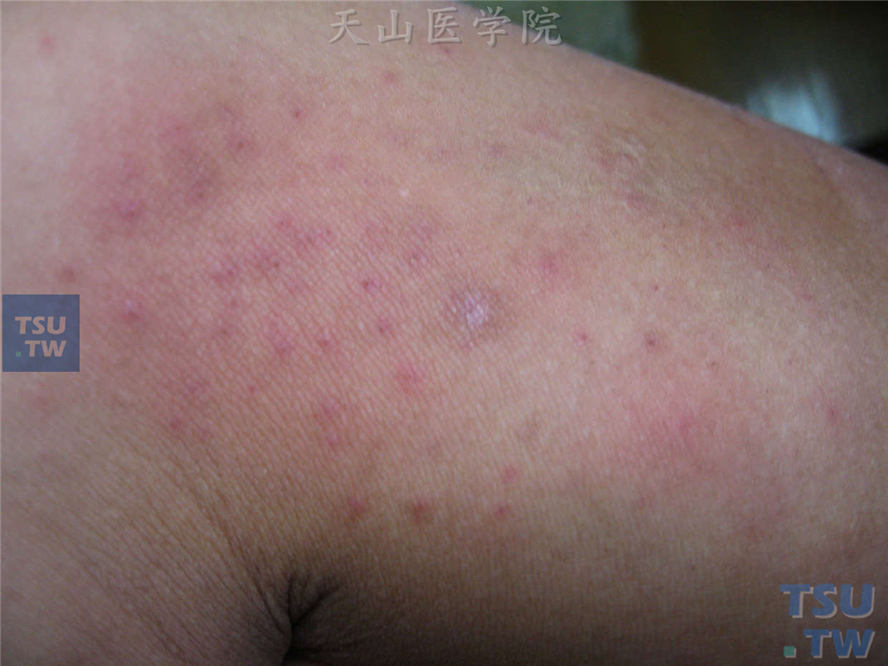 刺猬刺伤（hedgehog sting）的症状表现