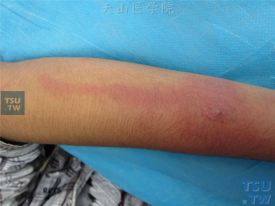 患者前臂被毒虫咬伤后出现线状的淋巴管炎