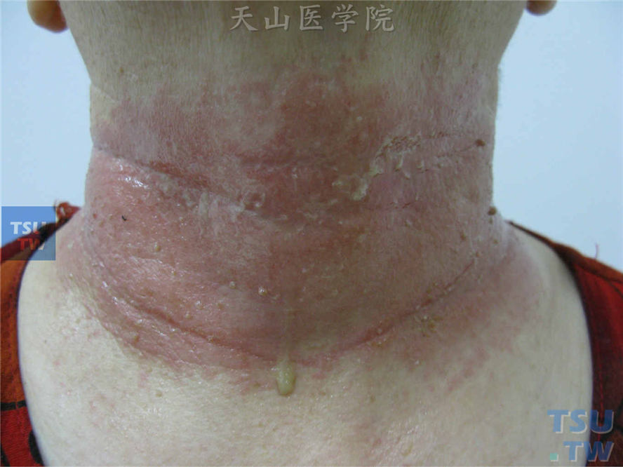颈部接触植物汁液刺激后沿颈纹方向紫红斑，其上糜烂、渗液