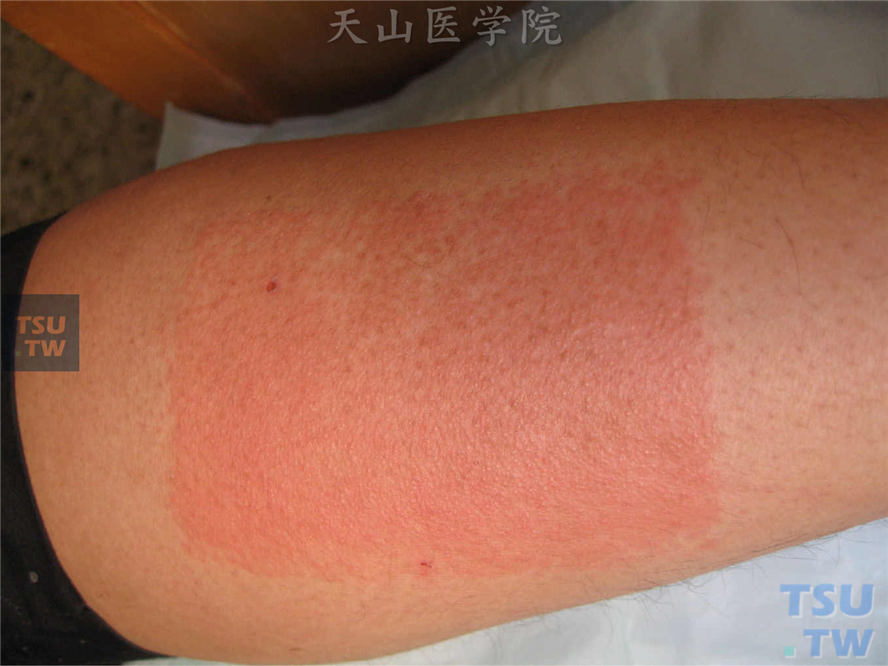 大腿帖敷膏药处发生水肿性红斑，皮损形态单一，边界清楚
