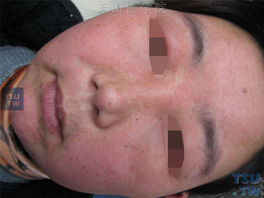 化妆品皮炎：面部弥漫红肿，密集粟粒大小丘疹