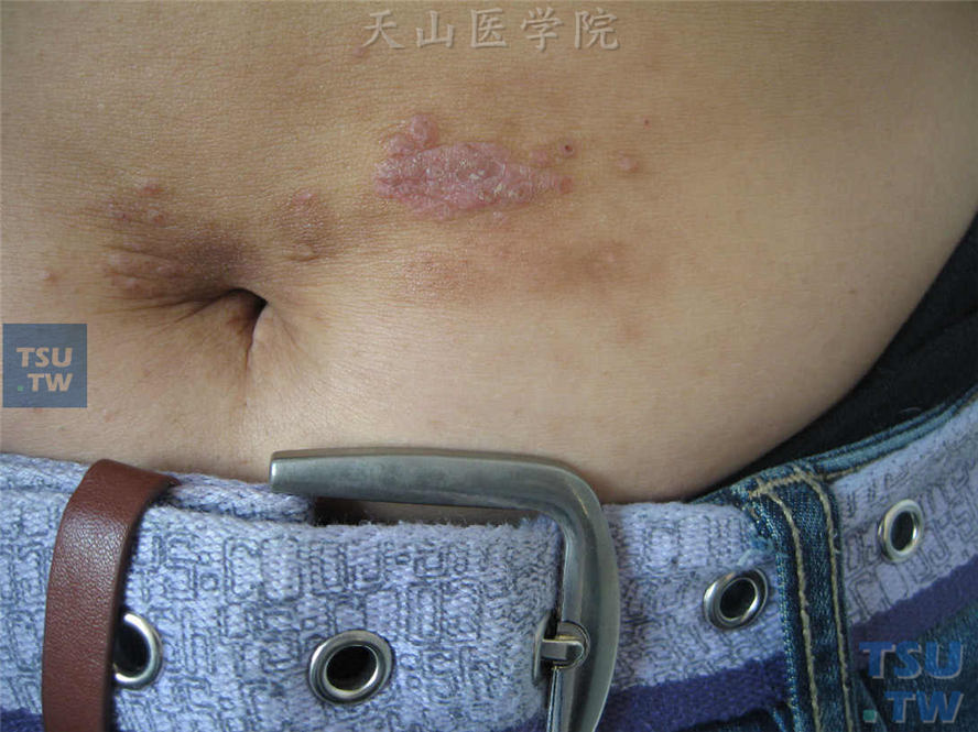 镍引起的脐周接触性皮炎