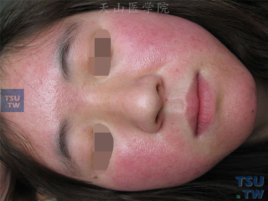 化妆品皮炎（cosmetic dermatitis）的症状表现