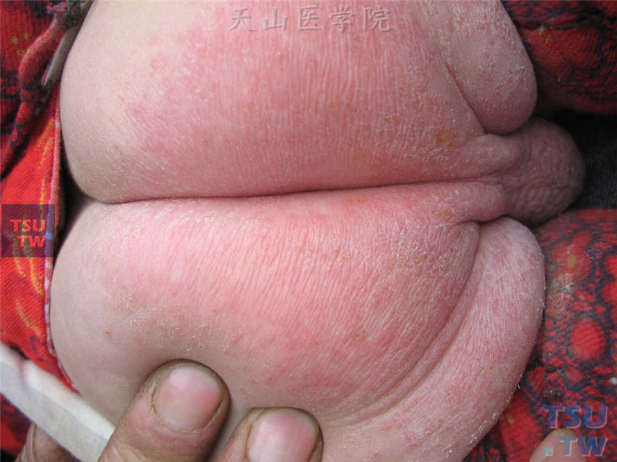 尿布皮炎湿疹样变并念珠菌感染