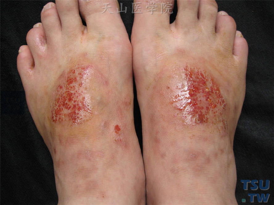 急性湿疹：双足背对称分布红斑、丘疹、糜烂、渗液，边界欠清