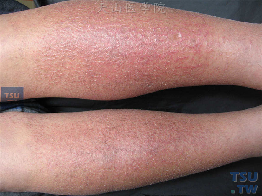 亚急性湿疹：双小腿伸侧暗红斑，表面皮肤龟裂状