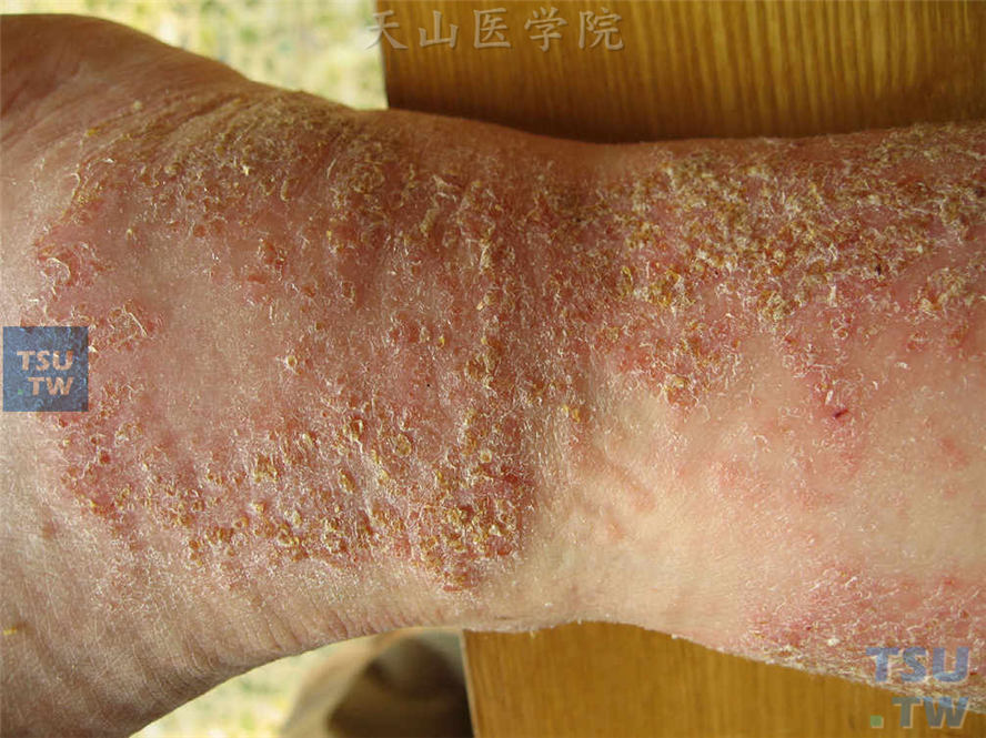 亚急性湿疹：手臂部红斑、丘疹、结痂