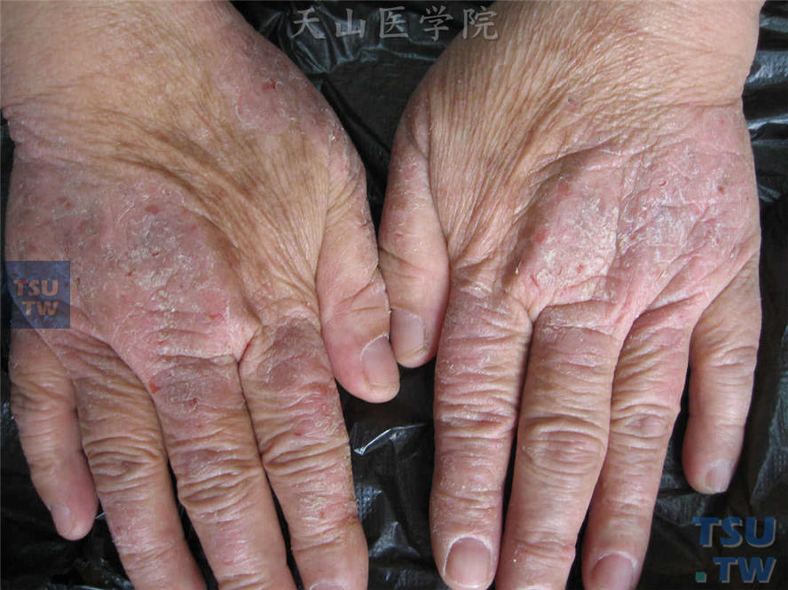 手部湿疹：手指背侧暗红斑，表面粗糙肥厚，被覆少许灰白色粘着性鳞屑