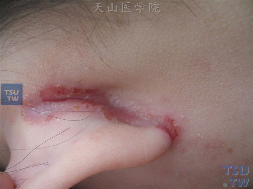 耳后湿疹：耳后红斑，皮肤返折处现状皲裂