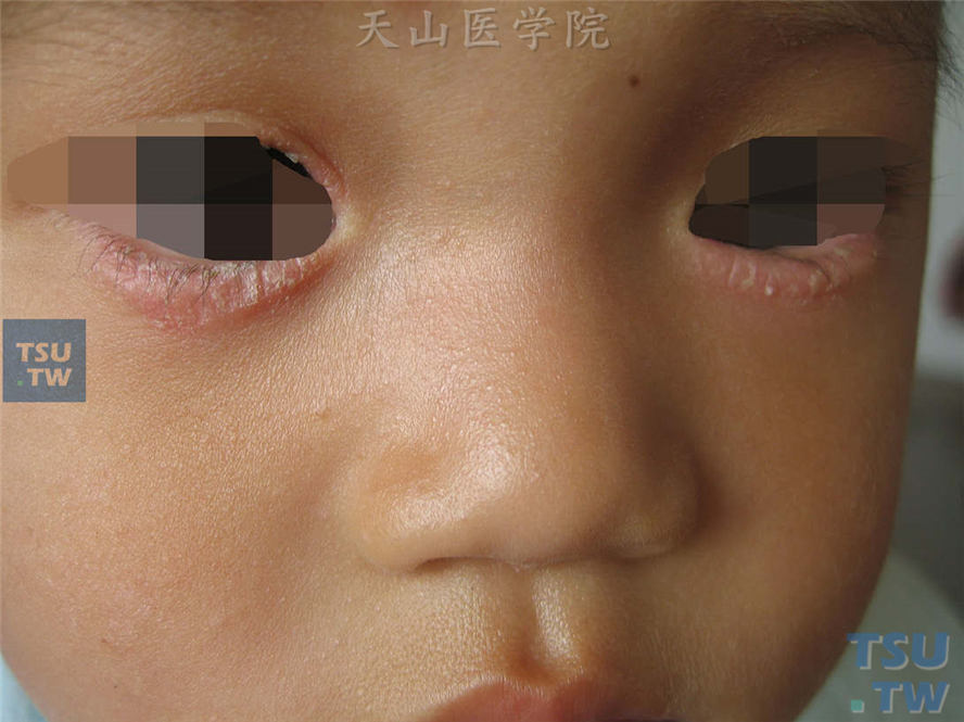 眼睑湿疹：双眼眼睑淡红斑，轻度浸润肥厚，表面干燥性鳞屑