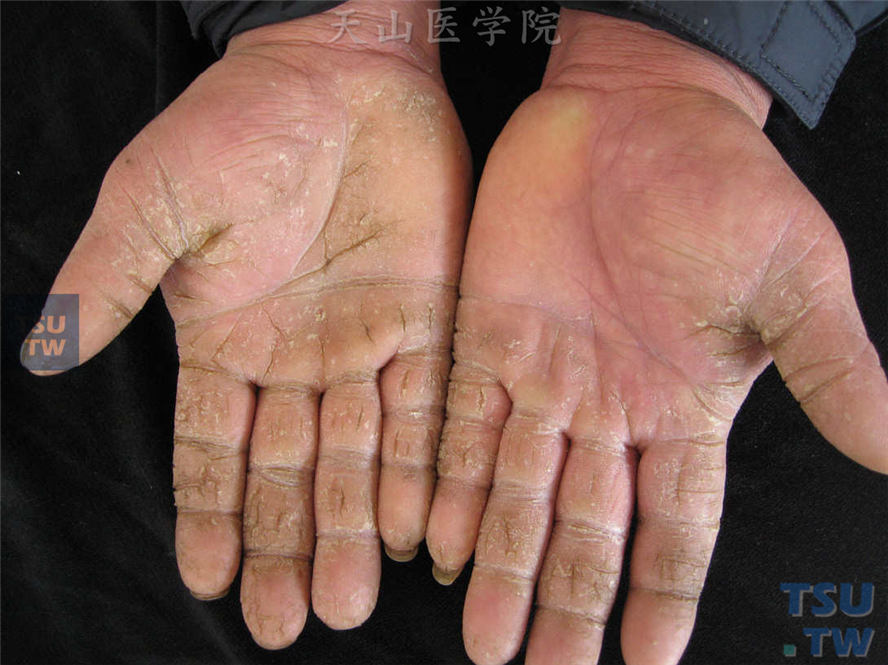 皲裂性湿疹：双手掌、手指掌侧皮肤角化过度，线状皲裂