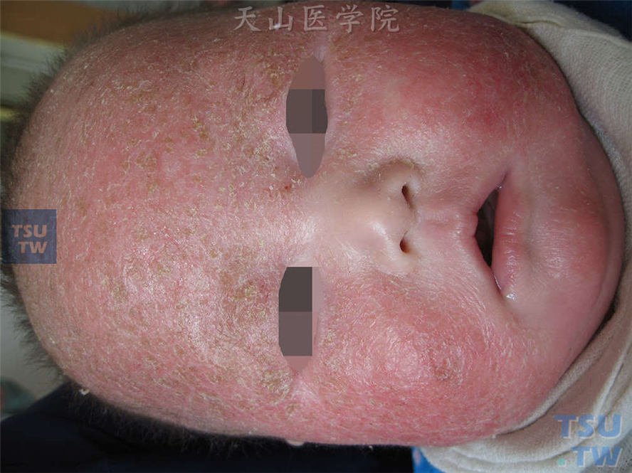 婴儿期：面部、头皮弥漫潮红，满布灰白色细碎鳞屑
