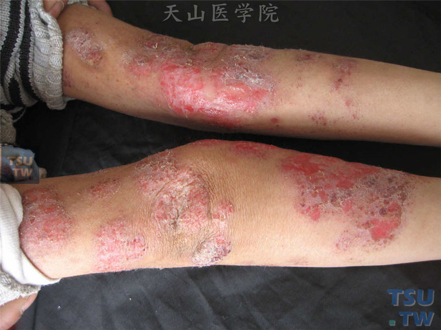 同一病人，双上肢伸侧暗红斑，苔藓样斑块，搔抓后表面糜烂、渗液、痂屑